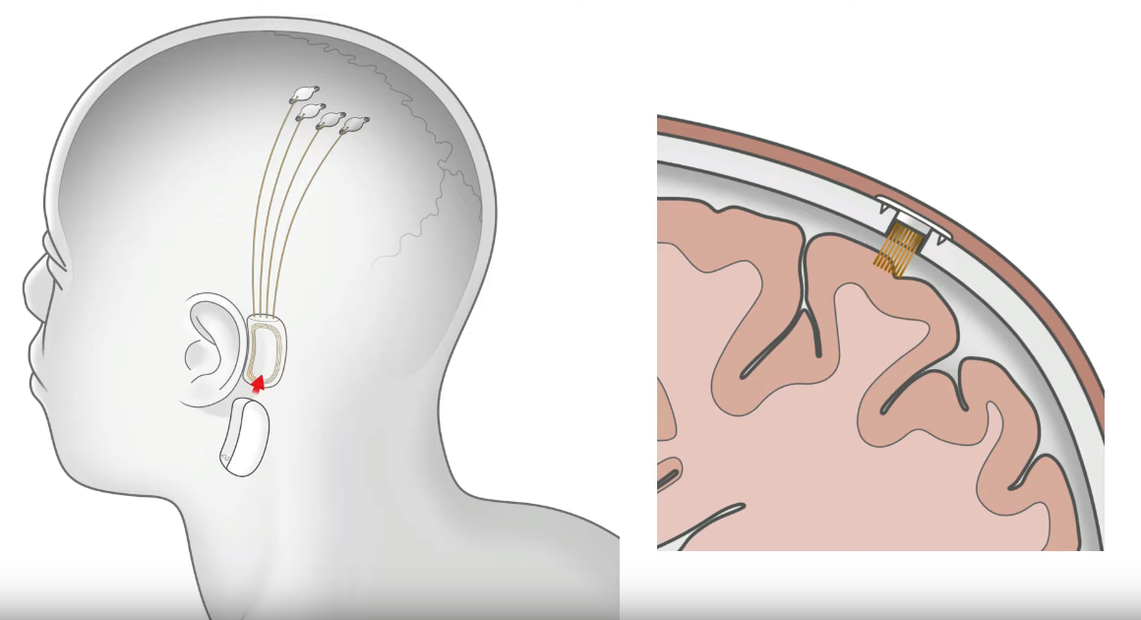 Neuralink