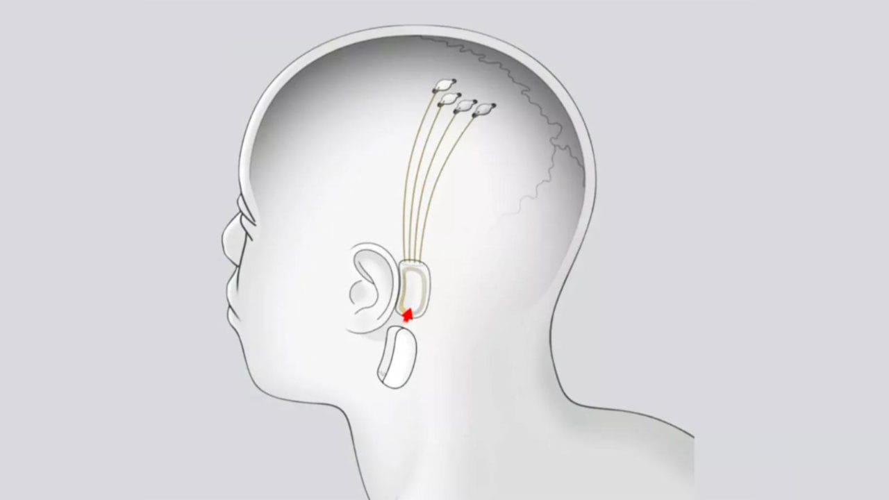 La nuova scienza per annunci: Musk informa il mondo sulle condizioni del primo paziente di Neuralink